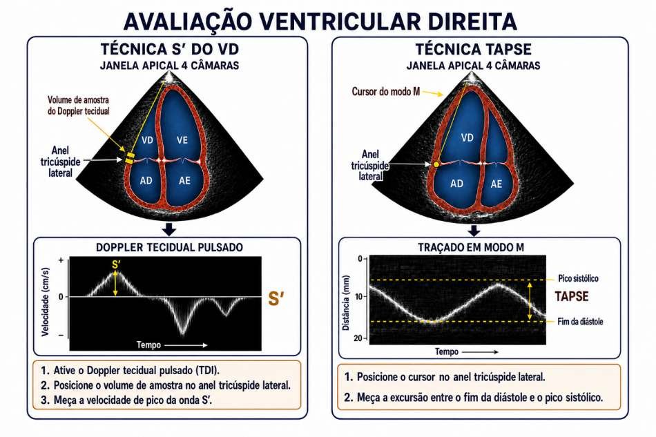 Técnicas S’ e TAPSE na avaliação ventricular direita