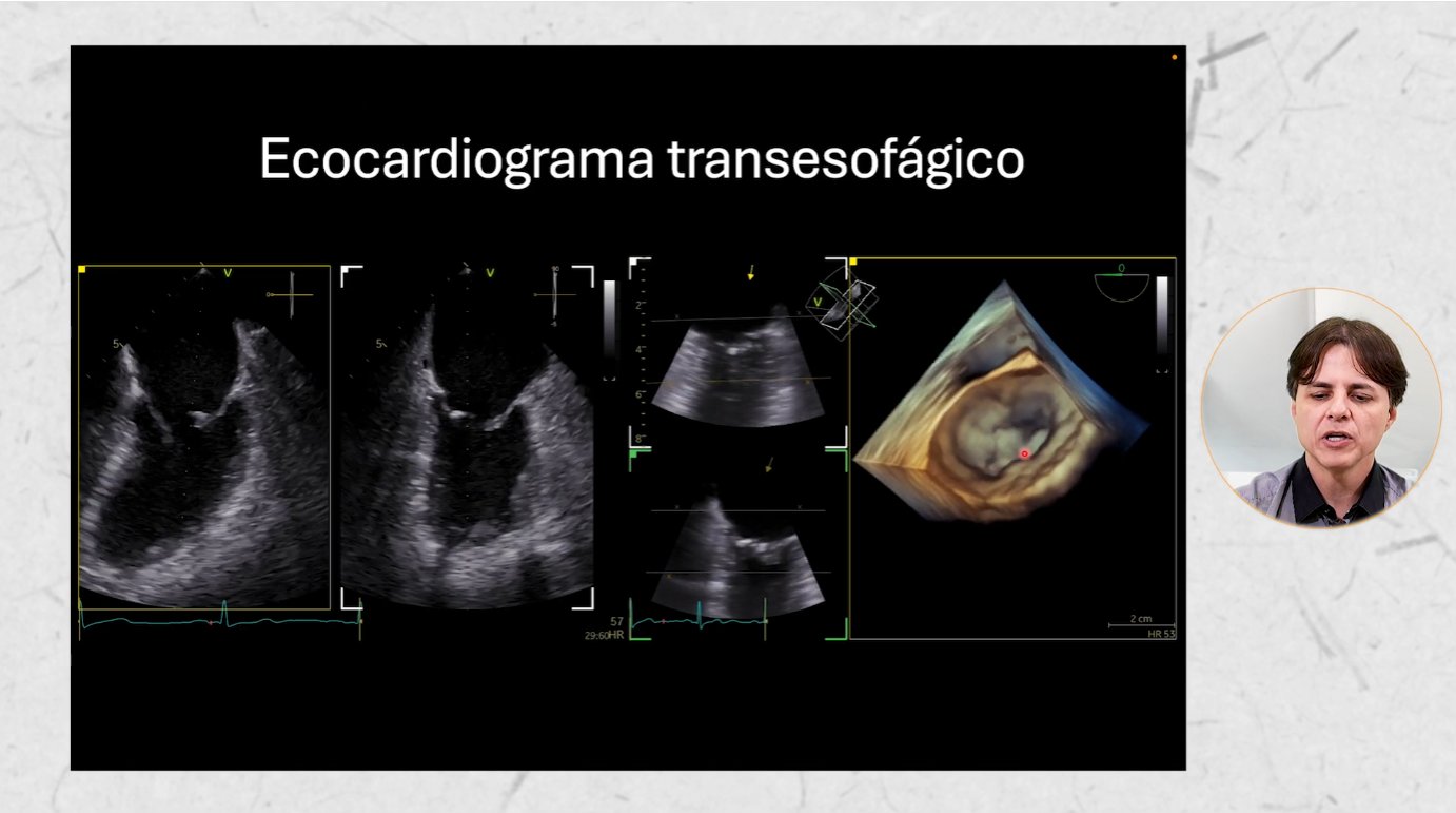 Videoaula de ecocardiograma transesofágico